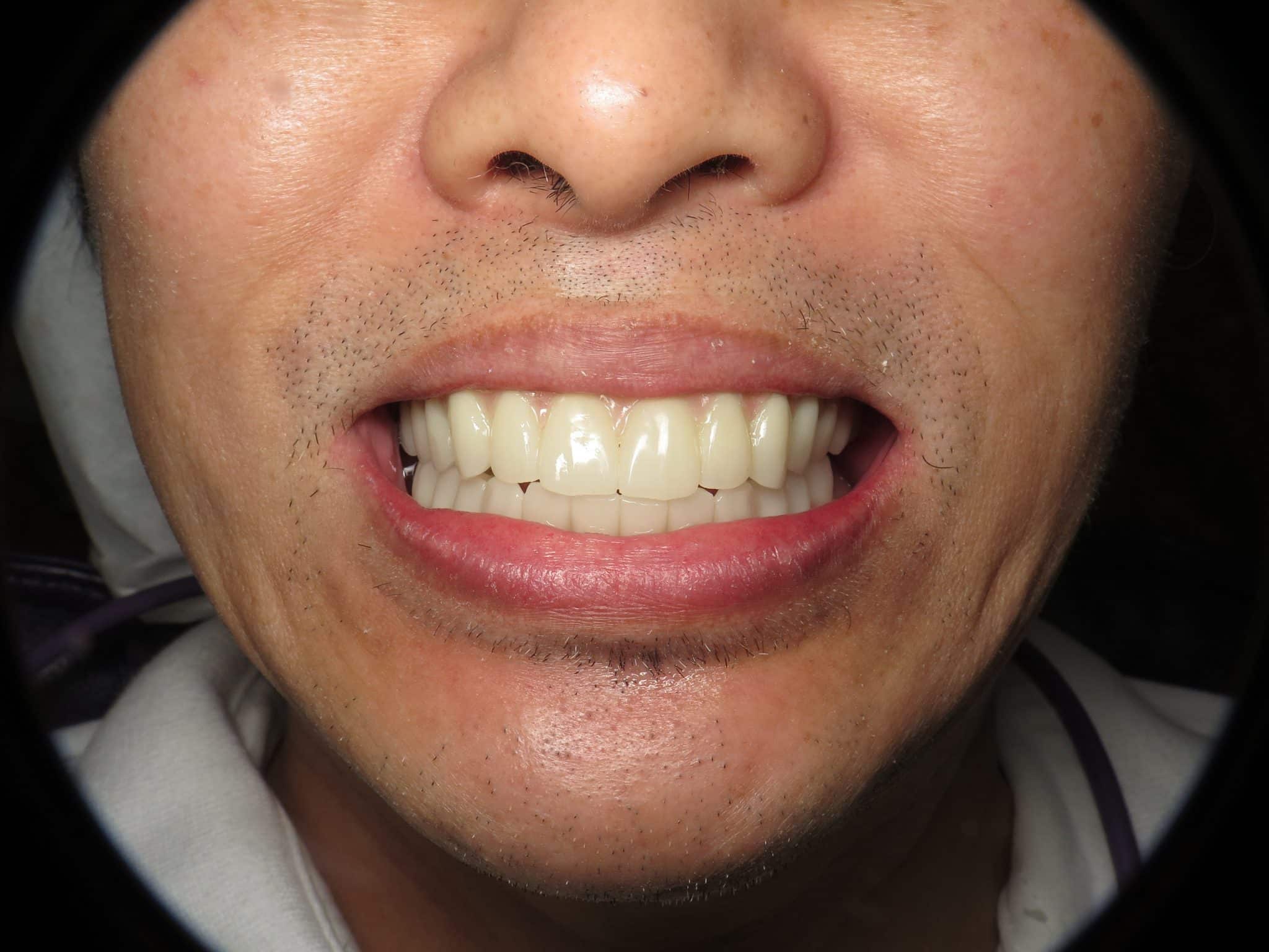 Temporary Full Implant Teeth. Why Do This Step? Ramsey Amin, DDS