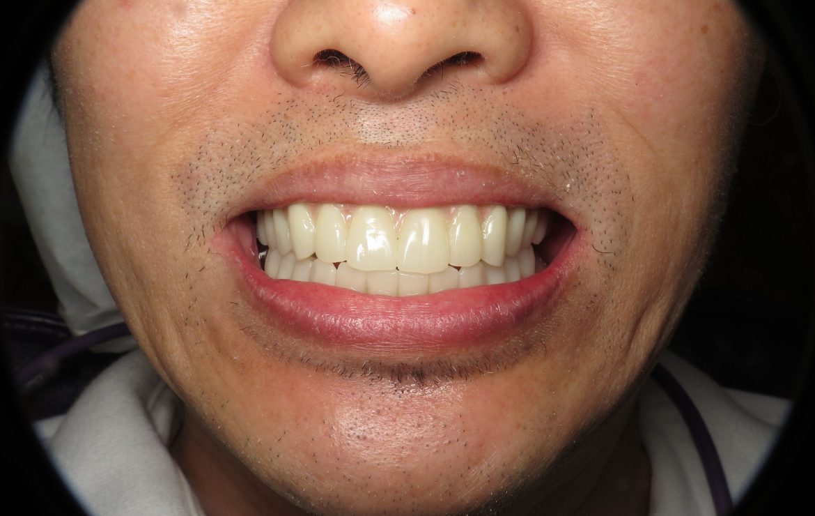Temporary Full Implant Teeth. Why Do This Step?
