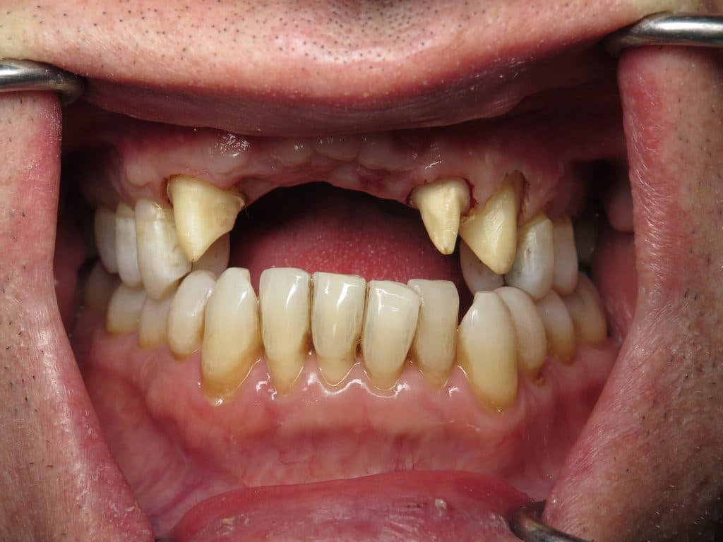 Missing front upper teeth