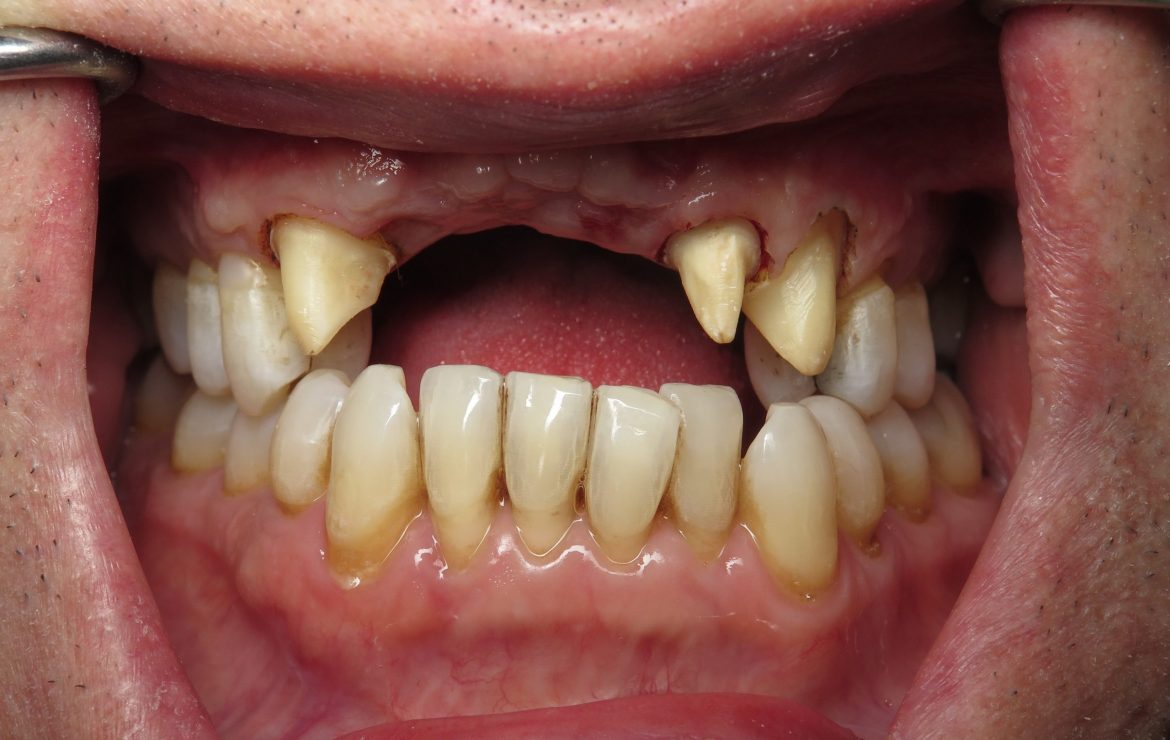 Bridge Better Than Dental Implants? VIDEO