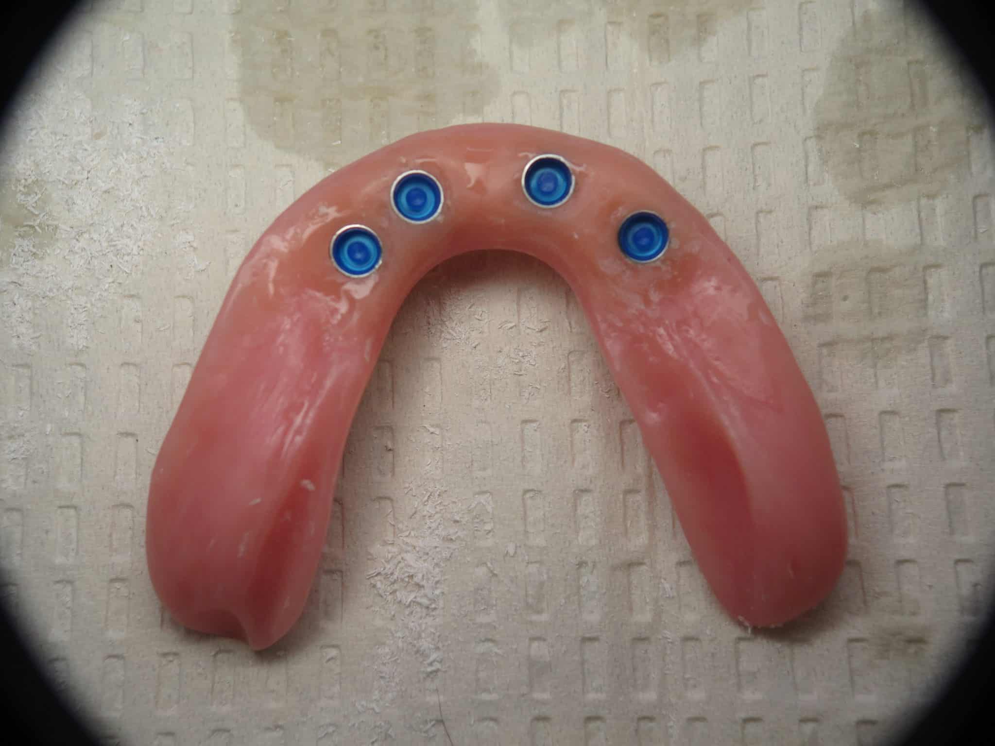 ComplicationsBone Graft For Failed Full Lower Dental Implants