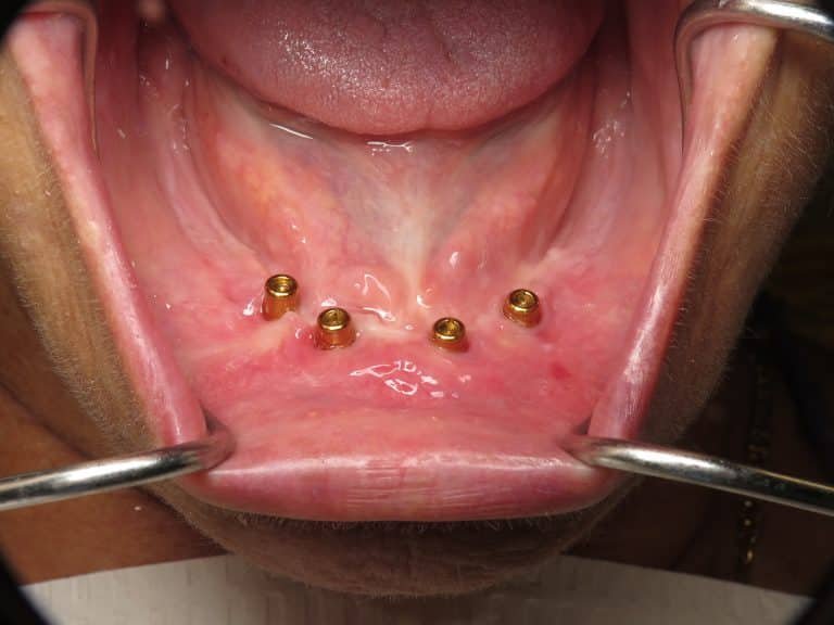 ComplicationsBone Graft For Failed Full Lower Dental Implants