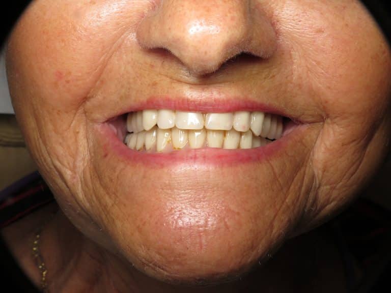 ComplicationsBone Graft For Failed Full Lower Dental Implants