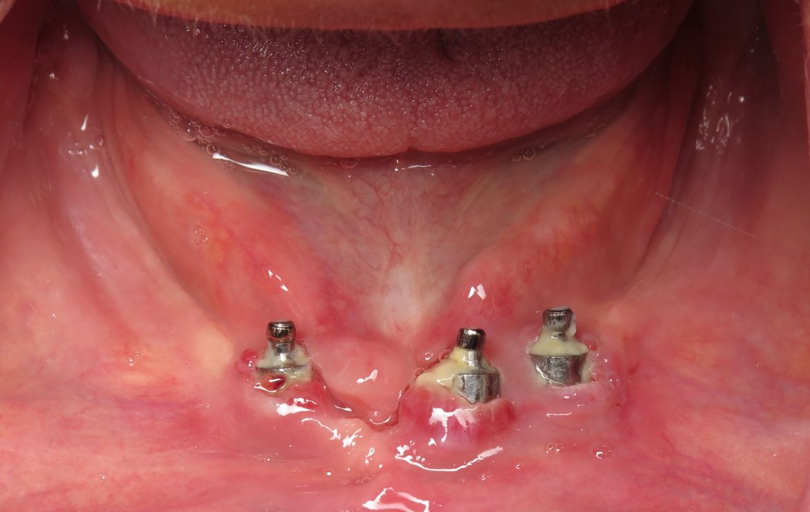 What is Peri-implantitis and What Do I Do About It? – Bone Loss Around Dental Implants ~Burbank Dentist, Ramsey Amin Reviews