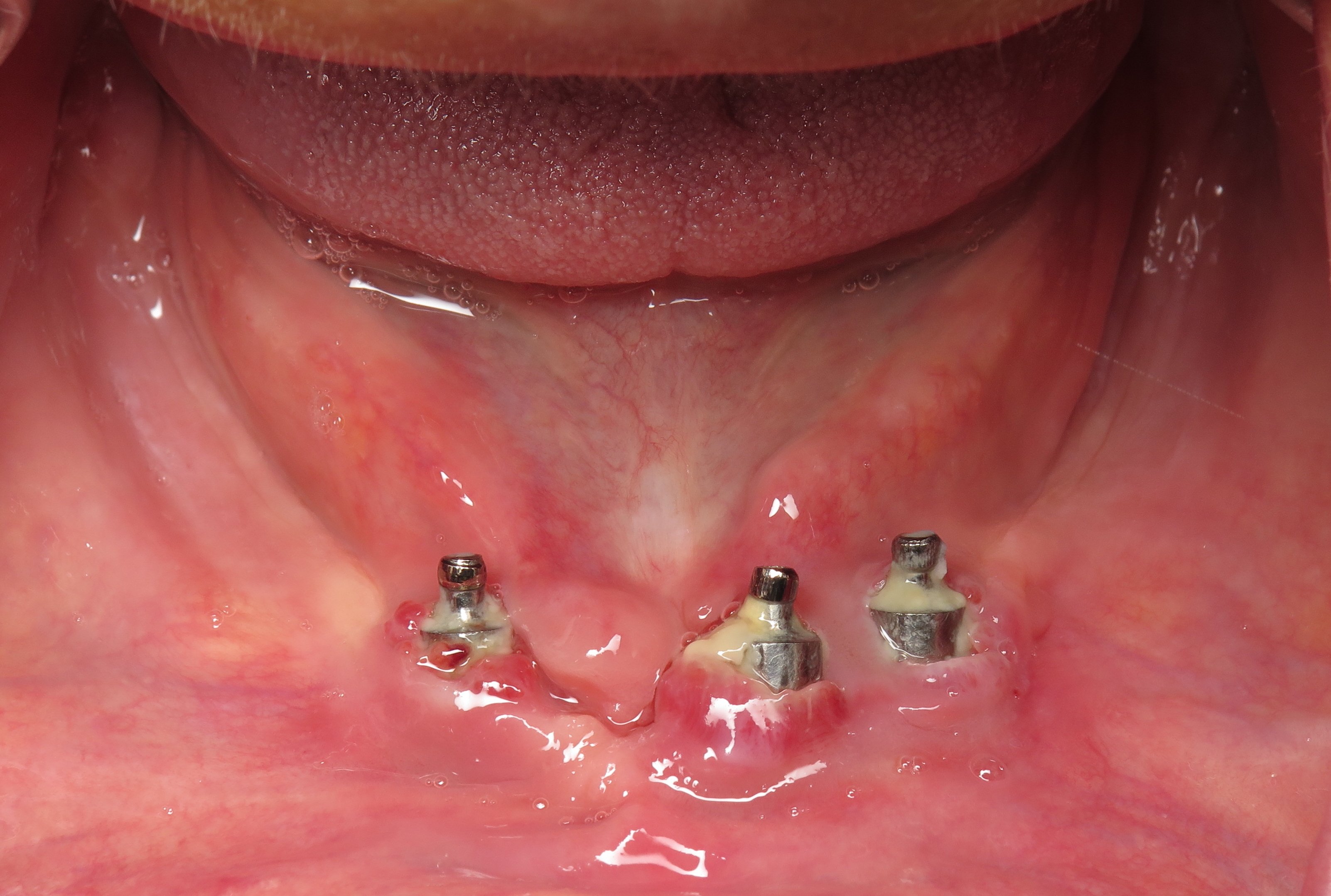 complications-bone-graft-for-failed-full-lower-dental-implants