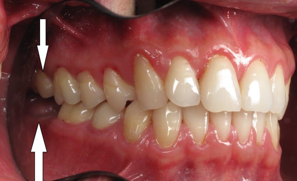 Mouth with labels for the teeth, gums, roof of the mouth, bottom