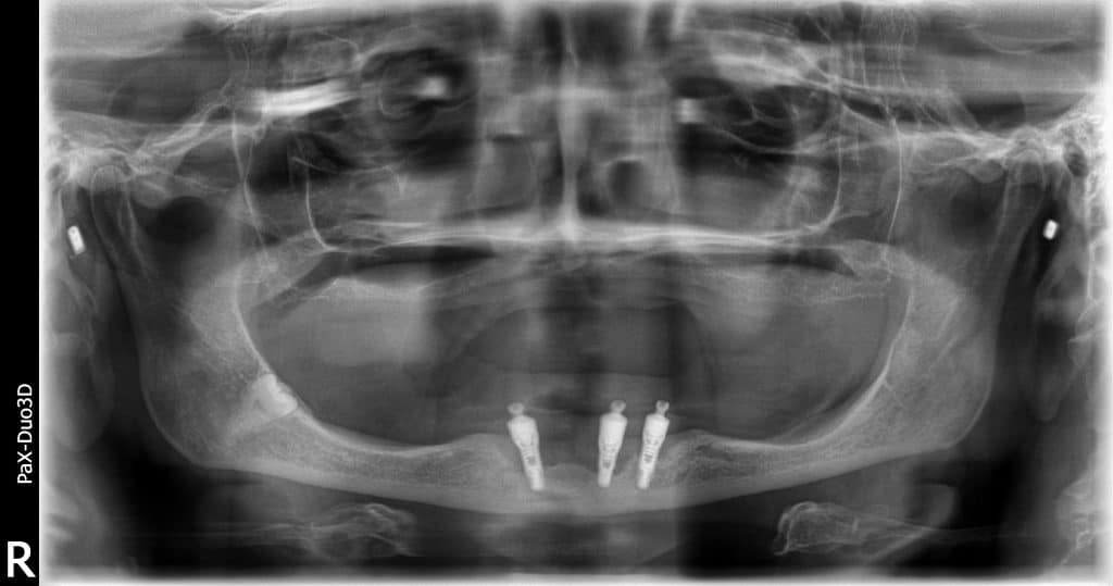 Panoramic failing dental implants