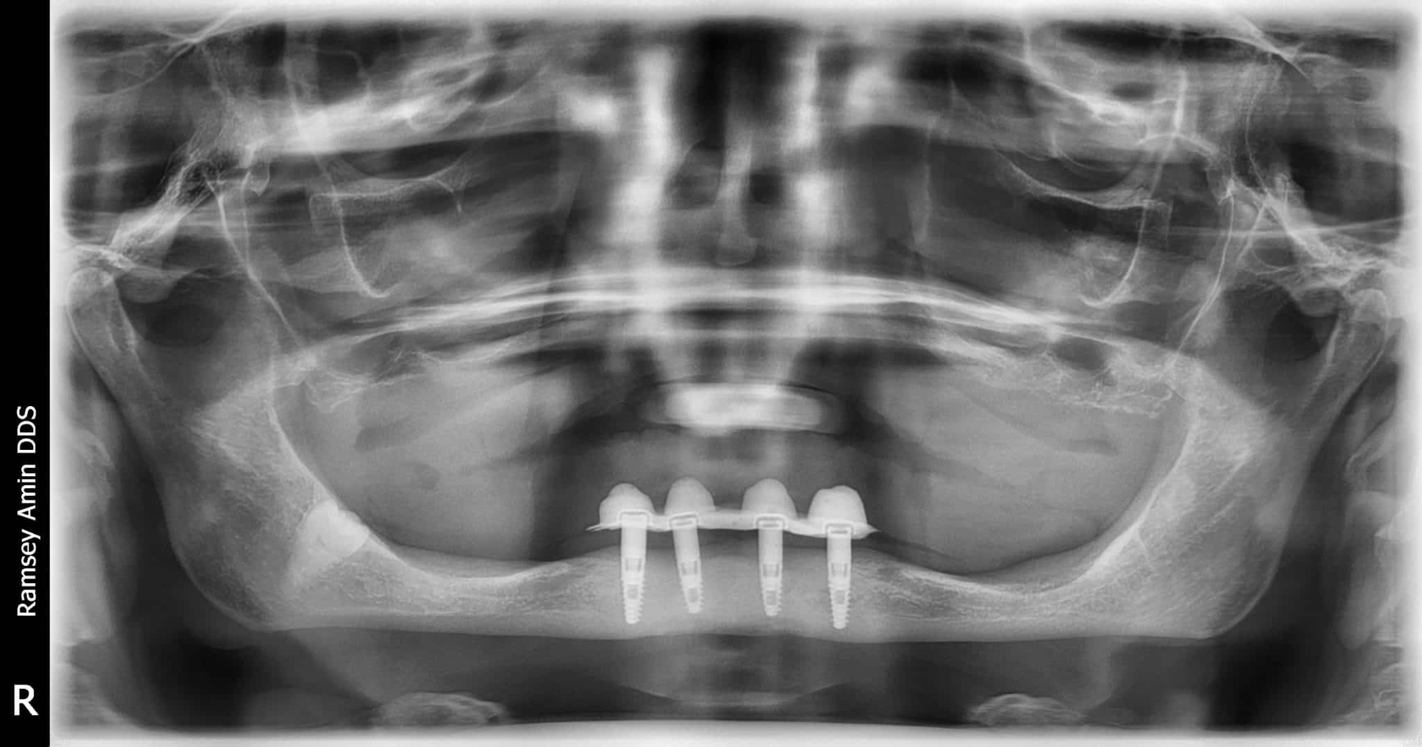 ComplicationsBone Graft For Failed Full Lower Dental Implants