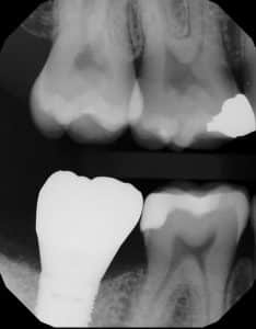 x-ray showing a dental implant for the molar