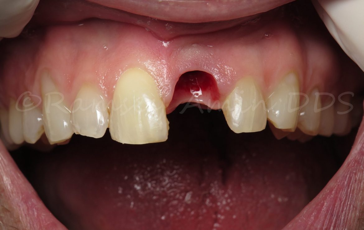 Center Front Dental Implant -Ramsey Amin DDS