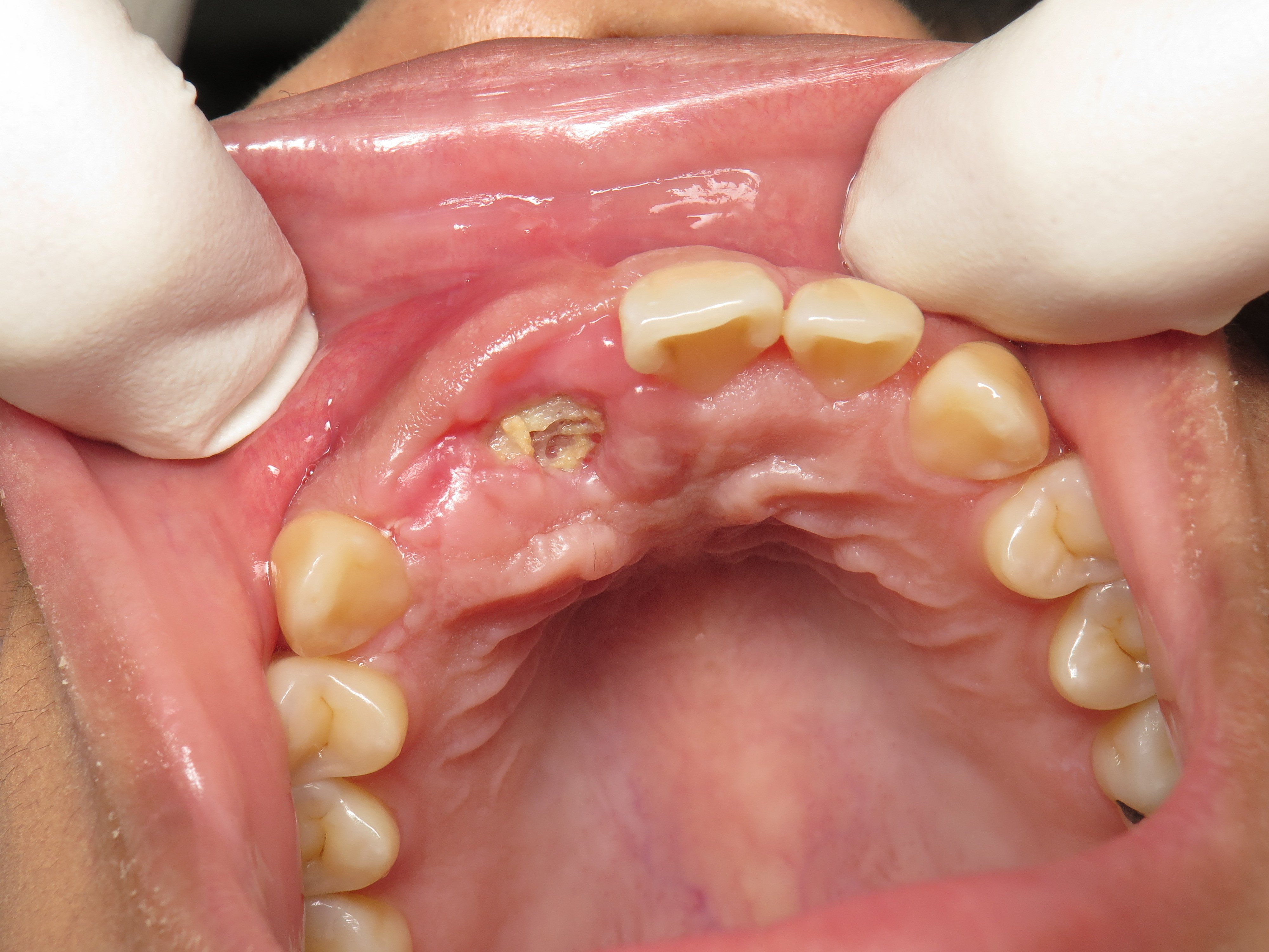 er-zi-k-r-lvett-n-zetelt-r-s-exposed-root-after-tooth-extraction