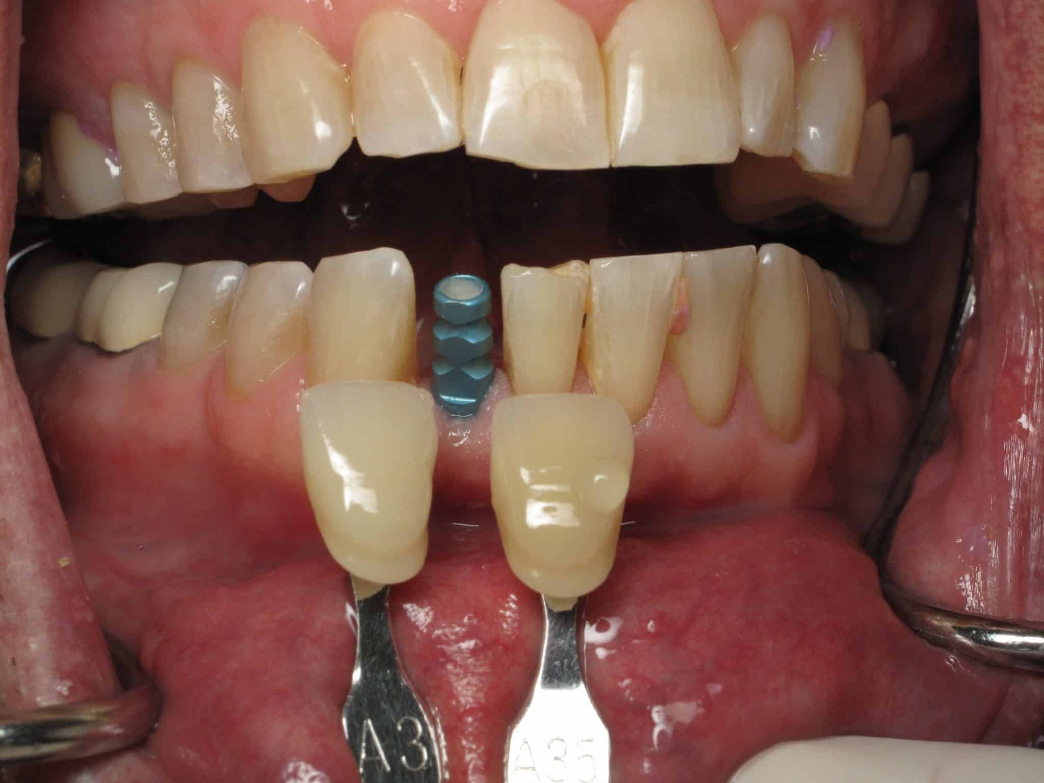 Lower Front Tooth Implants