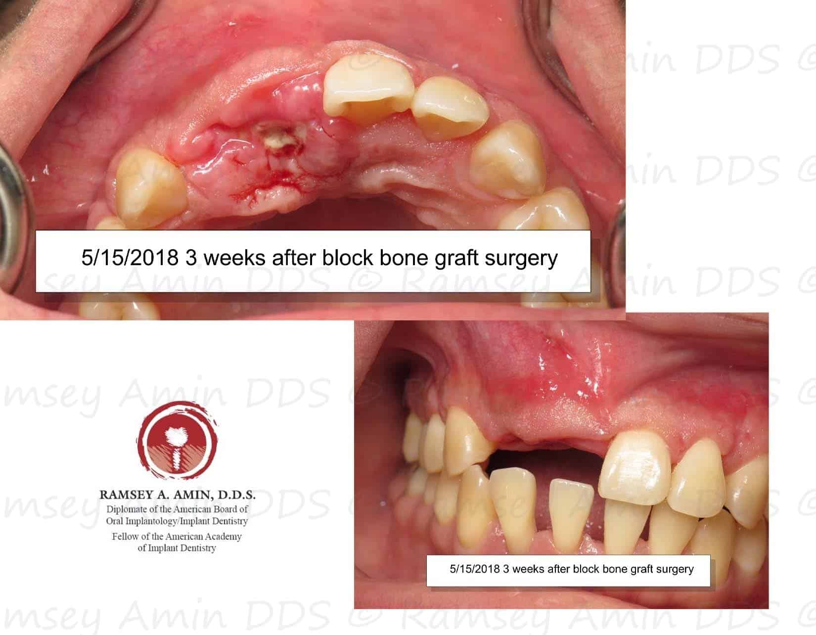 Complication Bone Graft Is Exposed Platelet Prf Treatment Ramsey Amin Dds