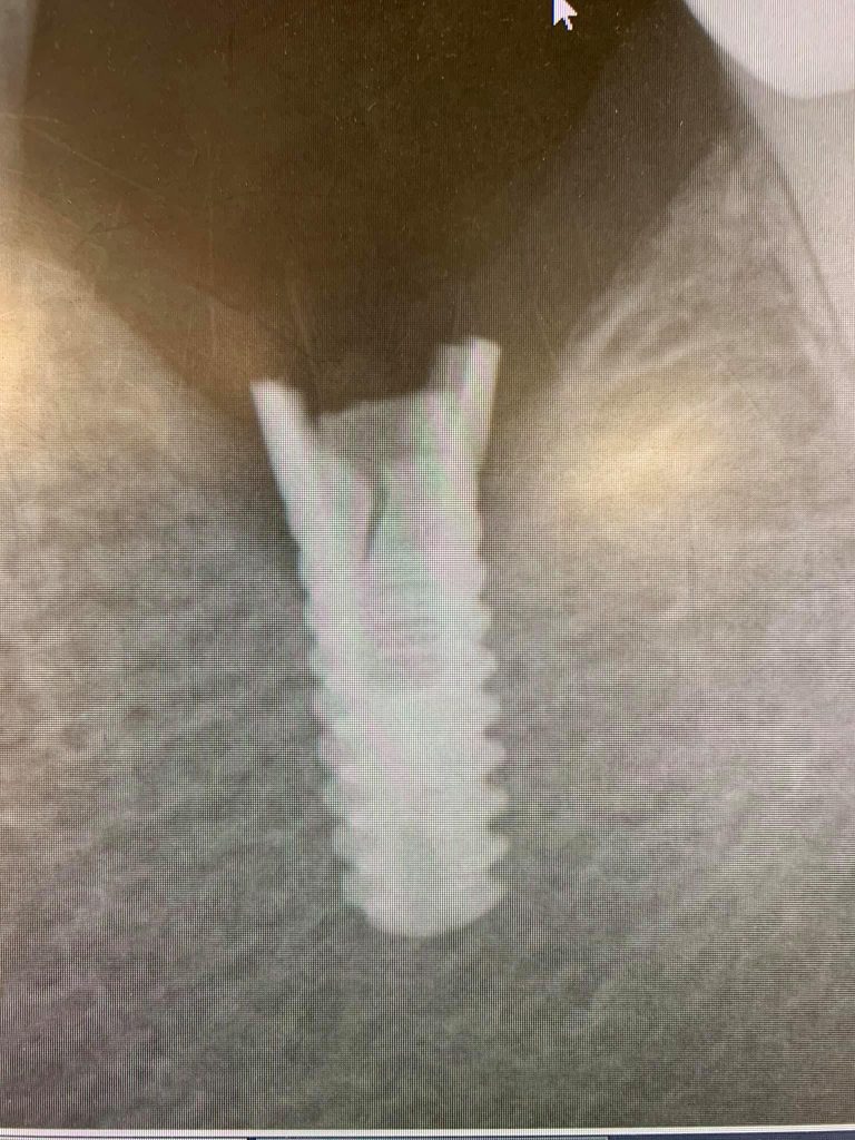 broken cracked titanium dental implant x-ray