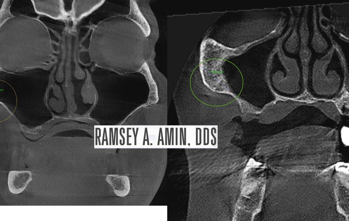 Zygomatic Dental Implants Bone Thickness/Thinness Comparison
