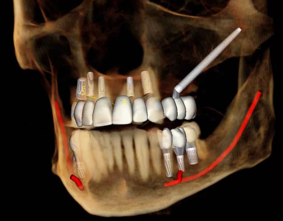 3D scan of zygomatic implant