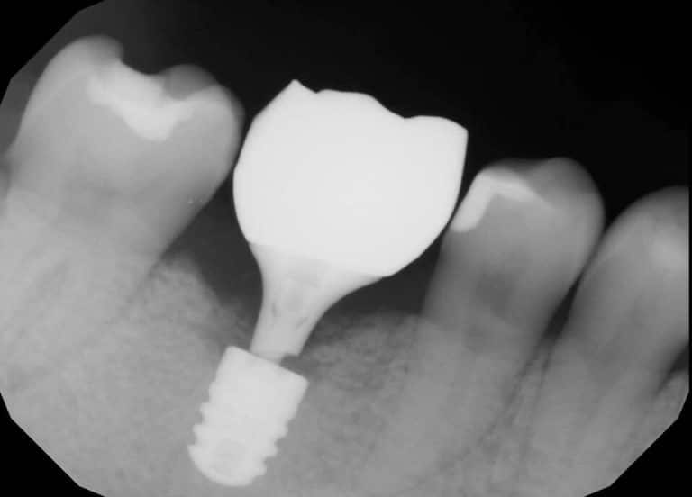 Complications Dental Implants Break!