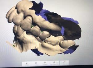 Digital dental implant impression