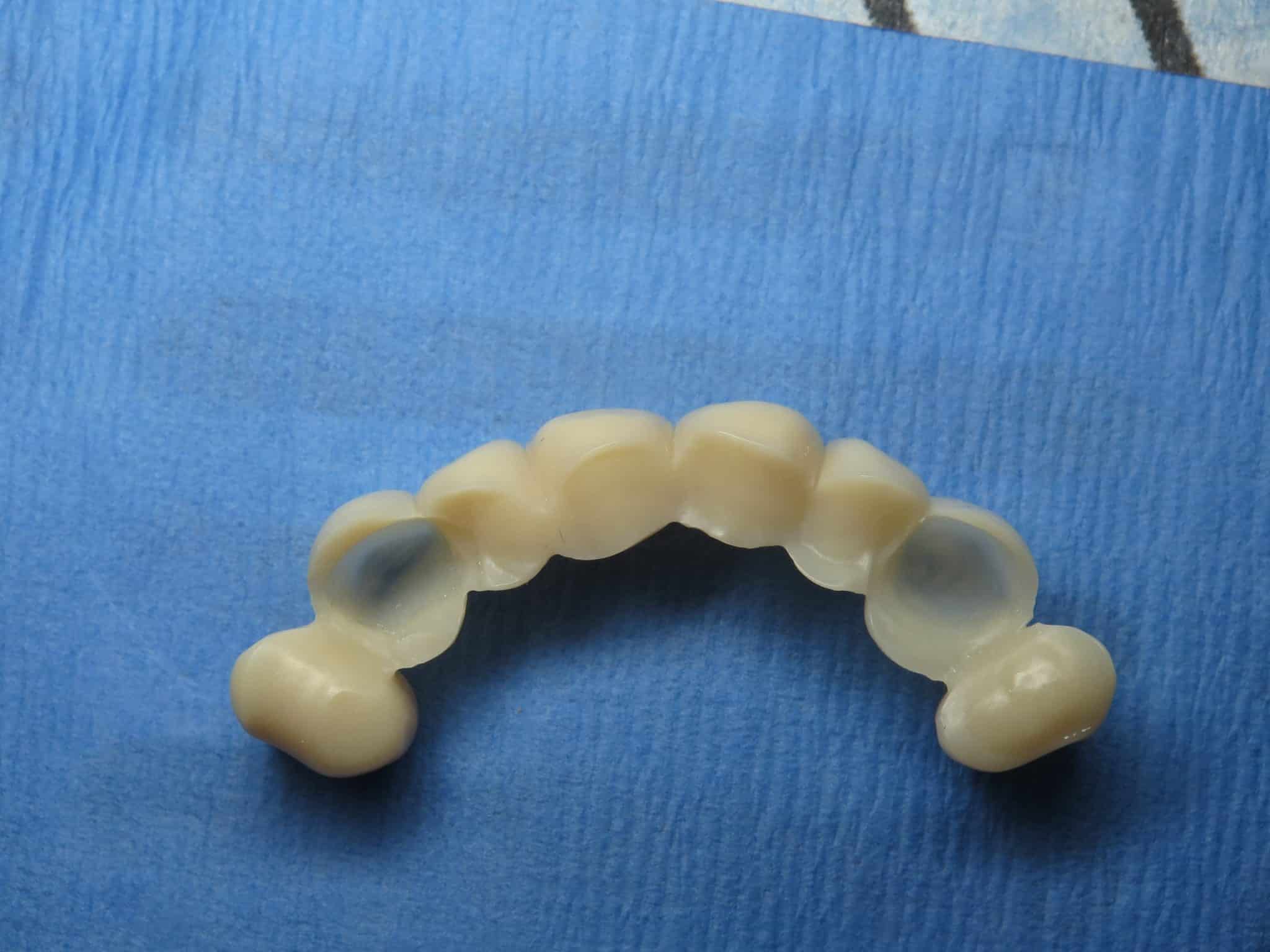 Flipper/Stayplate/Bridge Temporary Implant Bone Graft Facts