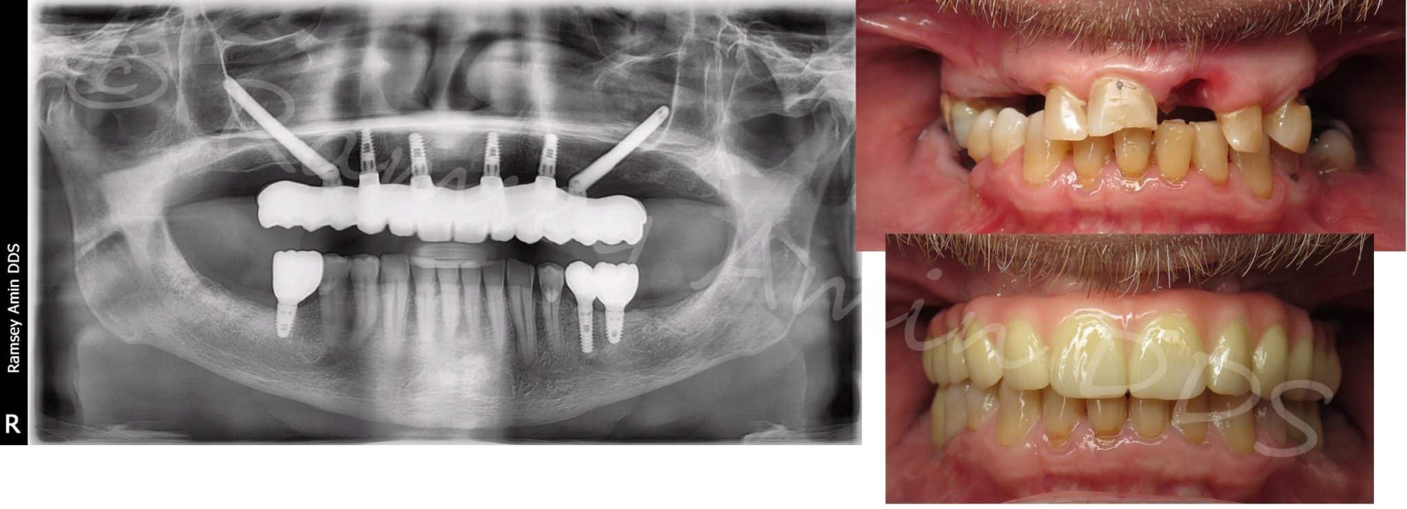 Zygomatic Dental Implants Burbank Dental Implants Dr. Amin