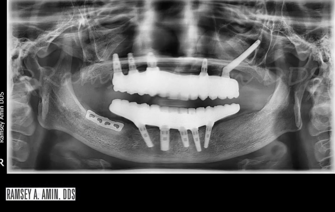 Prettau Zirconia Dental Implant Bridge with One Zygomatic Implant