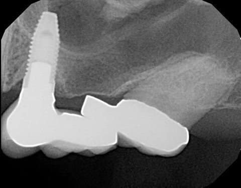 Xray of upper dental implant bridge