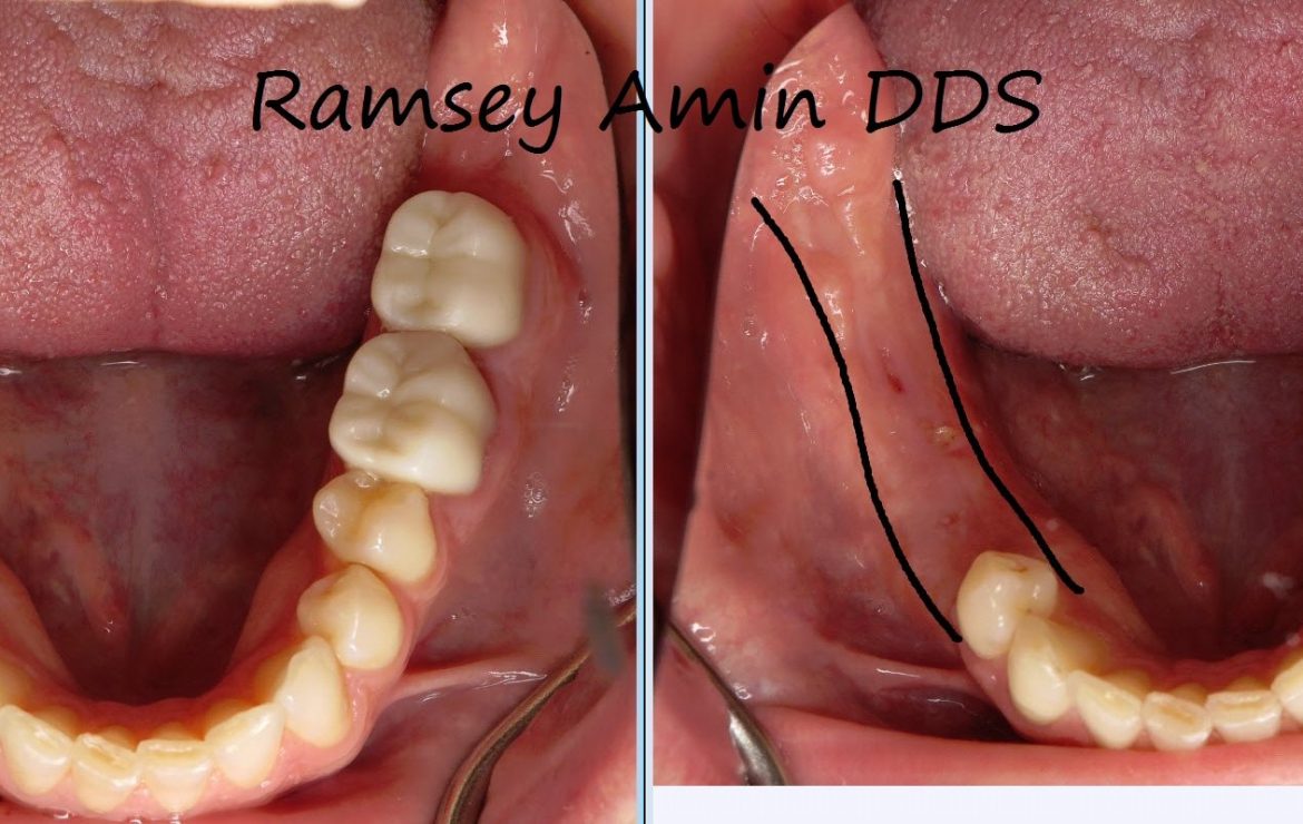 Big Bone Graft For Molars
