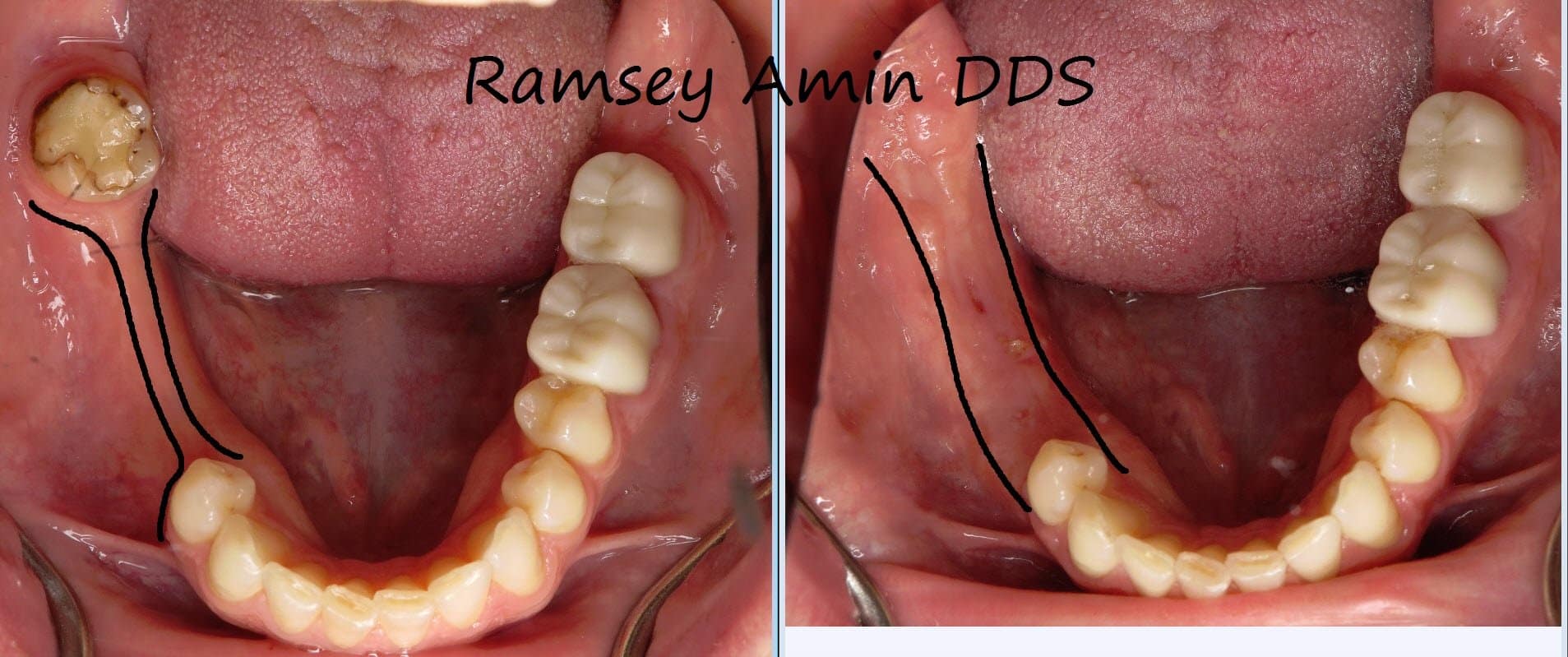 Bone graft results