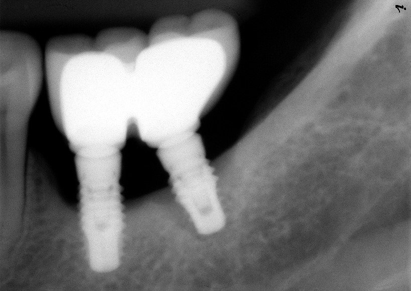Bone Loss Implants