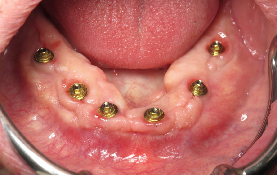 What are Multi-unit Abutments?