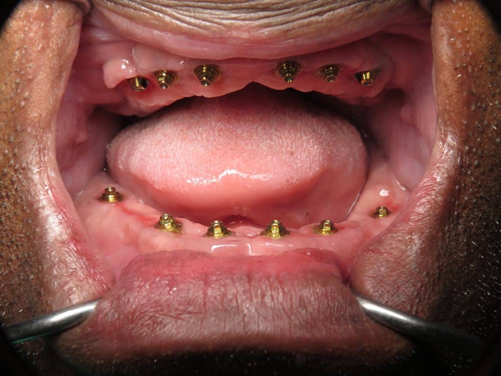 Multiunit abutment for impression