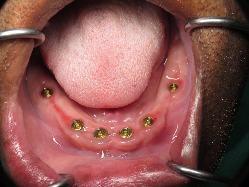 Multi-unit abutments