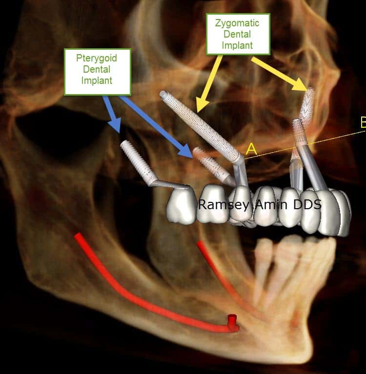 Pterygoid implants