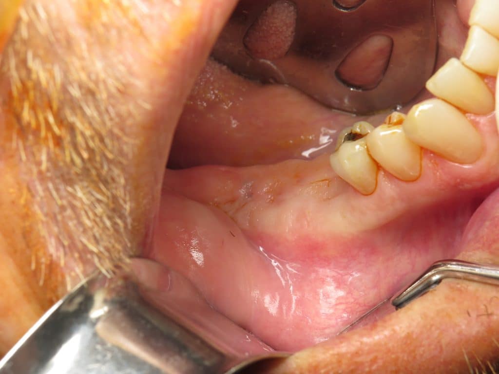 Is It Normal? Extraction Bone Graft Membrane (White) Showing