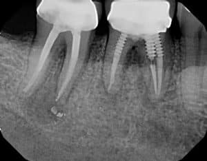 x-ray showing Failing root canals with bone infections