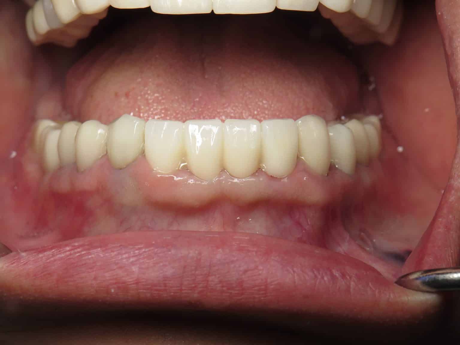 Immediate Implant Bridge Lower Jaw Front Teeth