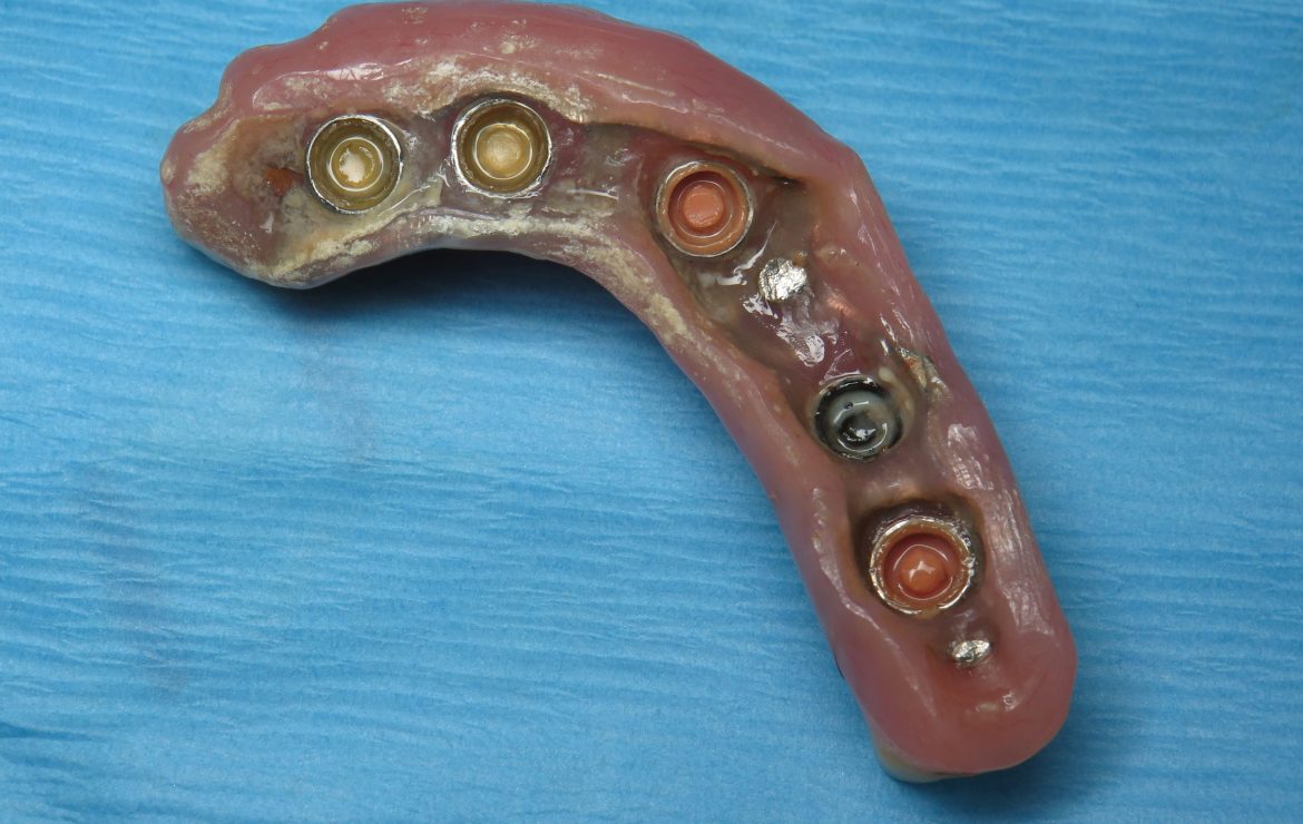 Screwed In Bridge Instead Of Overdenture