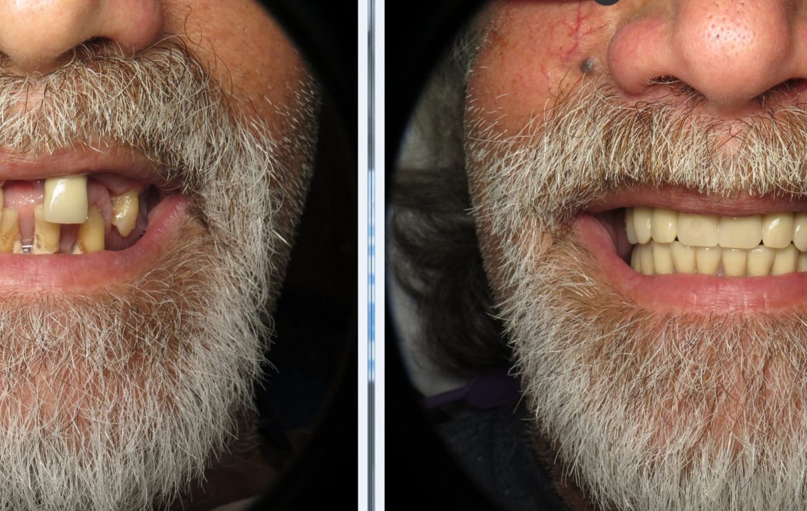 What Will My Dental Implant Teeth Look Like The Next Day?