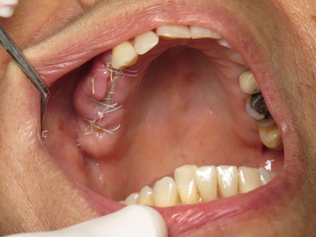 Bone graft/membrane in mouth