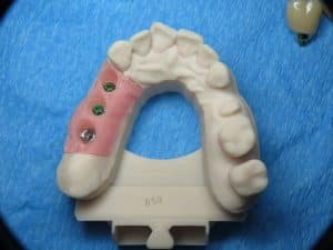 Digital dental model of teeth