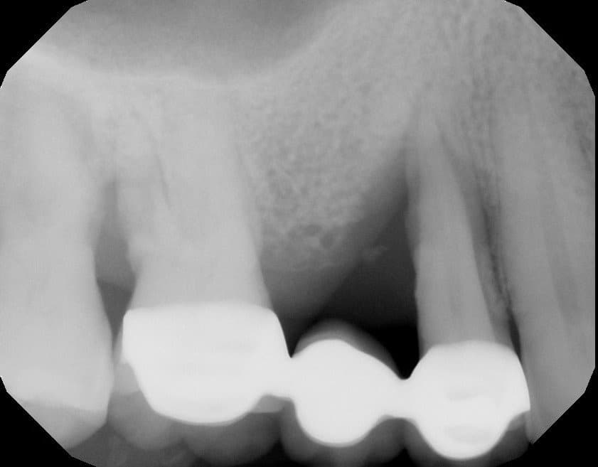 Xray bone loss bridge