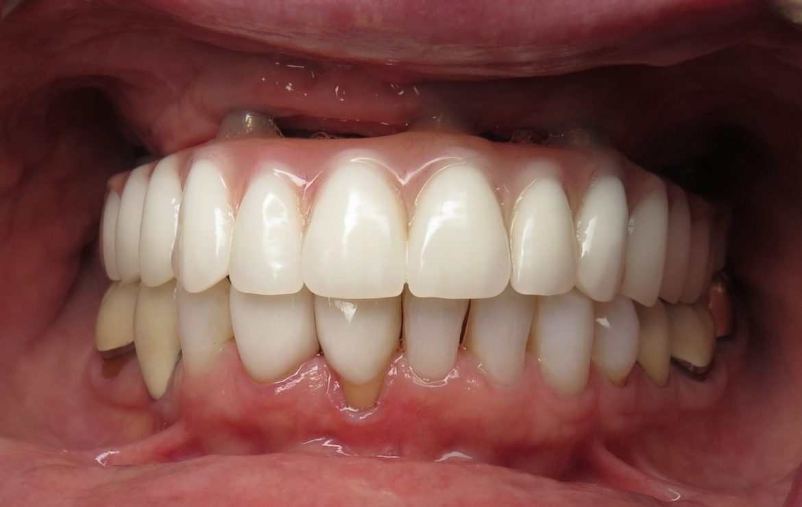 Gap Space Under My Implant Bridge