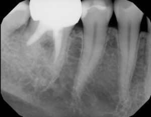 root canal failing x-ray