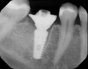 x-ray custom healing abutment dental implant