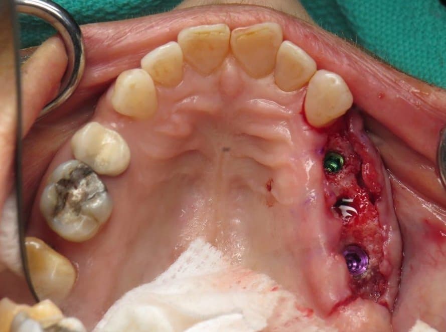 Dental implants open flap blood