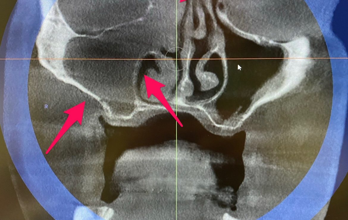 Clogged Blocked Sinus For Zygomatic Implants