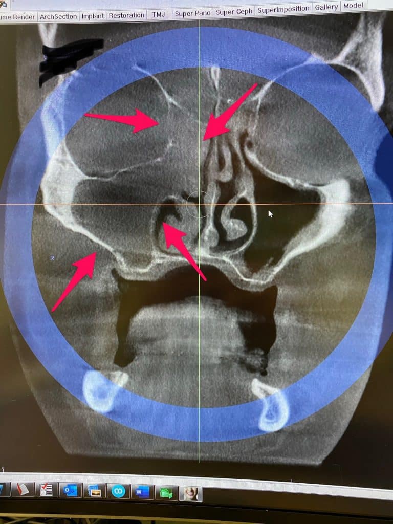 Clogged sinus indicated by red arrows. The healthy sinus is pitch black. ​