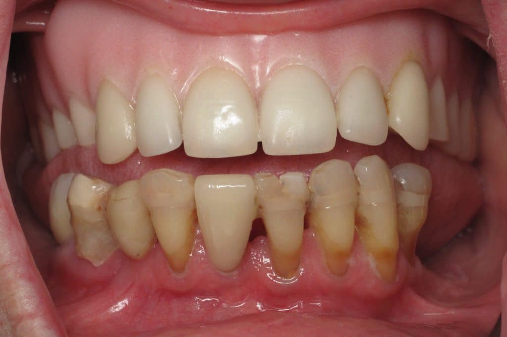 Should I Pull All of My Teeth and Get Dental Implants?