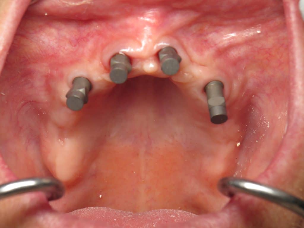 Upper full arch dental implant digital impression scanbodies