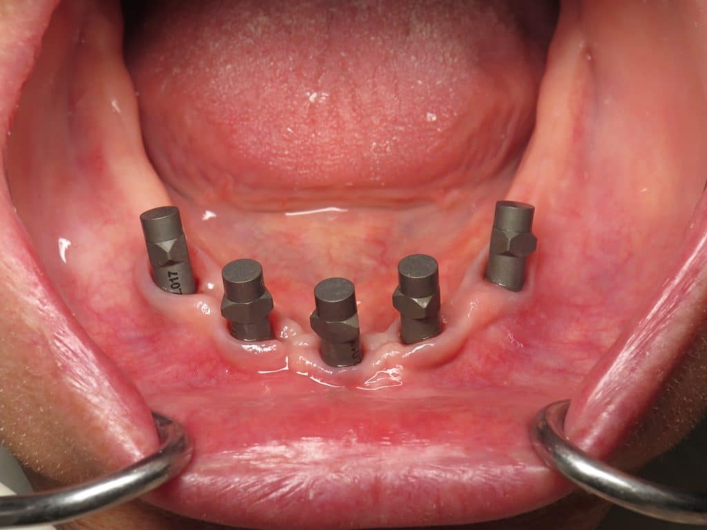 Lower full arch dental implant digital impression